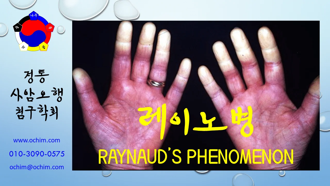비과학적 양의학 53 - 레이노병 치료 방법