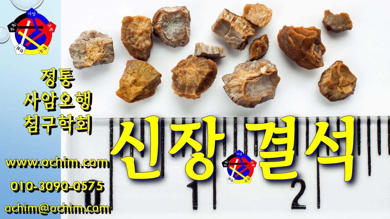 신장 결석 치료 방법 및 사례 - 사암침법, 사암오행침, 오행침